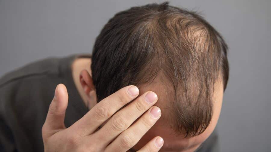 prolaktin naik setiap kali pmo (rambut rontok)
